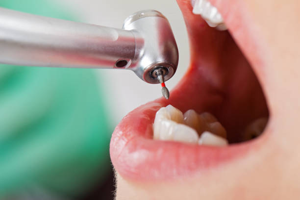Best Urgent Care for Lost Fillings or Crowns in Conway, FL